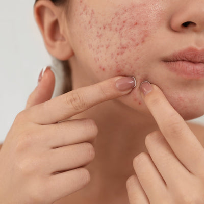 Acne